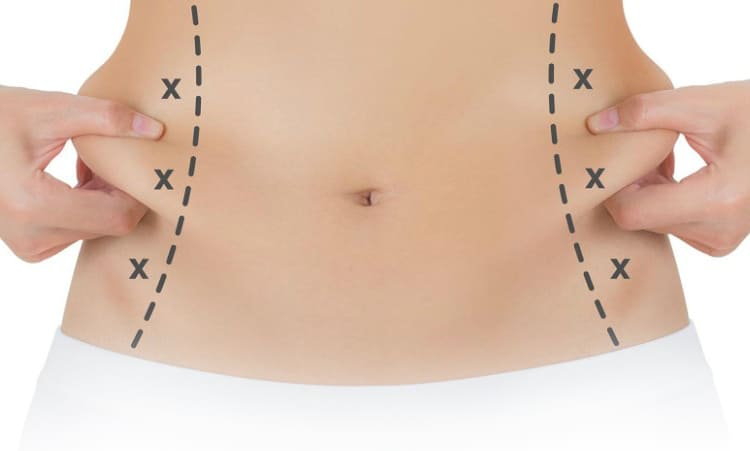 Liposuzione Liposuzione